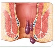 Piles Symptoms