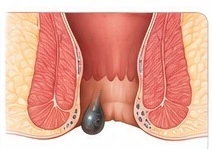 Piles Symptoms